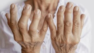Artrite Reumatoide: Entenda os Sintomas, Diagnóstico e Tratamento